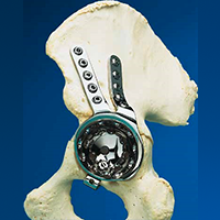 Endo Model Partial Pelvis Replacement from Link
